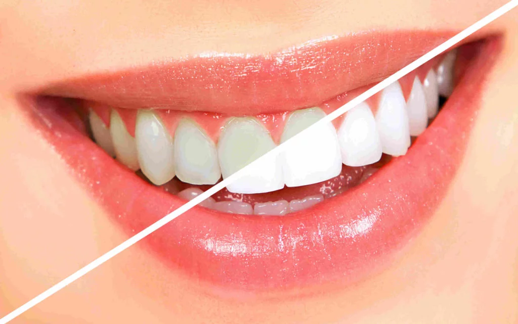 Dental Whitening